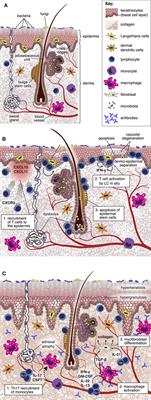 Unraveling the Mechanisms of Cutaneous Graft-Versus-Host Disease